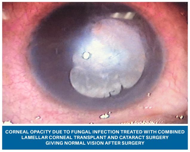 Corneal Opacity due to Fungal Infection