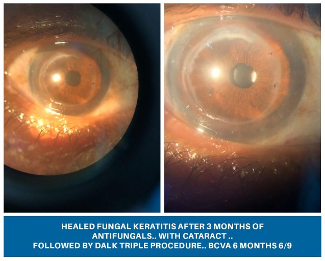 Healed Fungal Keratitis after 3 months of Antifungals